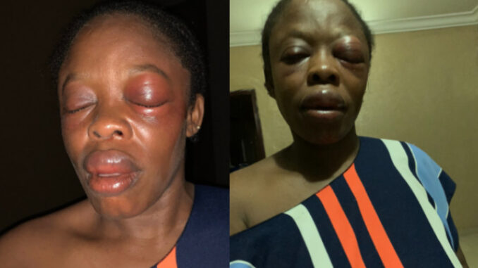 Voice over artist attacked by one-chance operators in Ikeja (Photos)